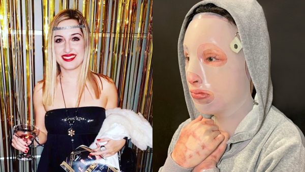 Η Ιωάννα Παλιοσπύρου δείχνει για πρώτη φορά το πρόσωπό της μετά την φρικτή επίθεση με το βιτριόλι (Pics)